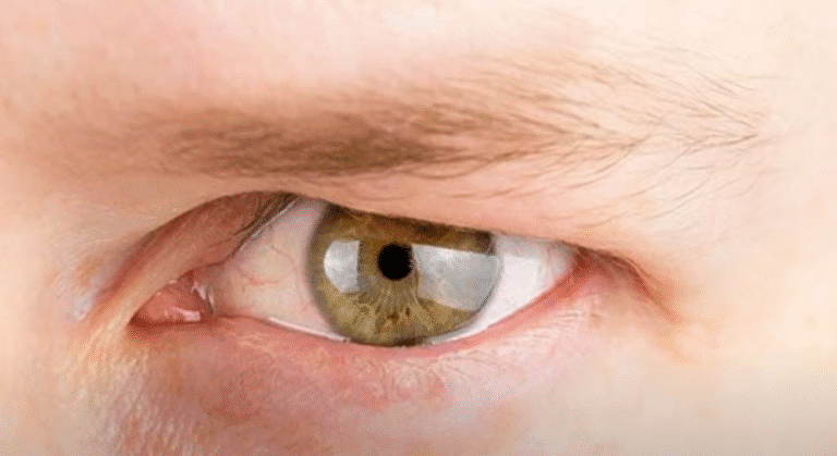 Hooded Eyes