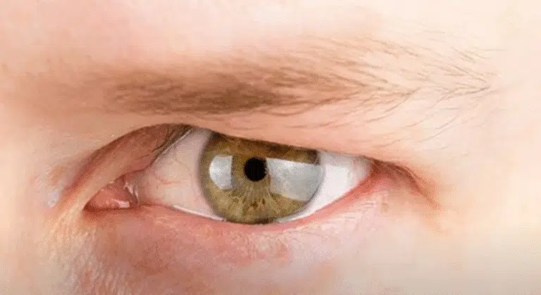 Hooded Eyes