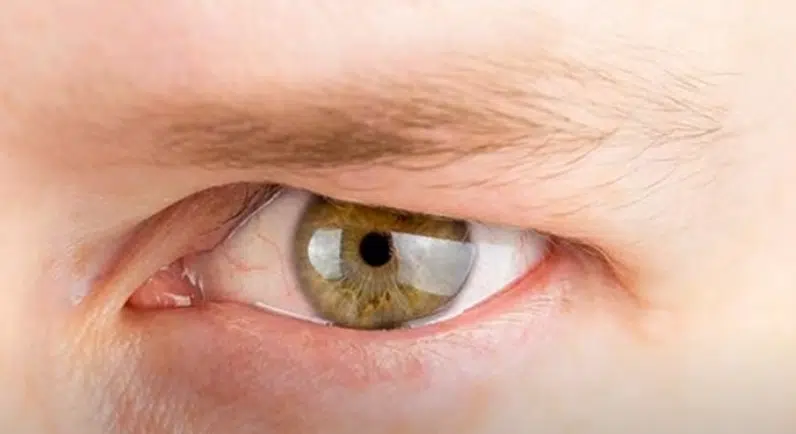 Hooded Eyes